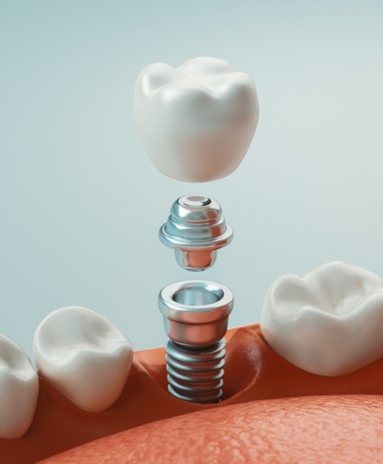 Illustrated model of a dental implant in Arlington Heights