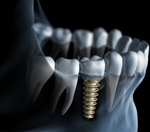 Illustrated x ray of a person with a dental implant