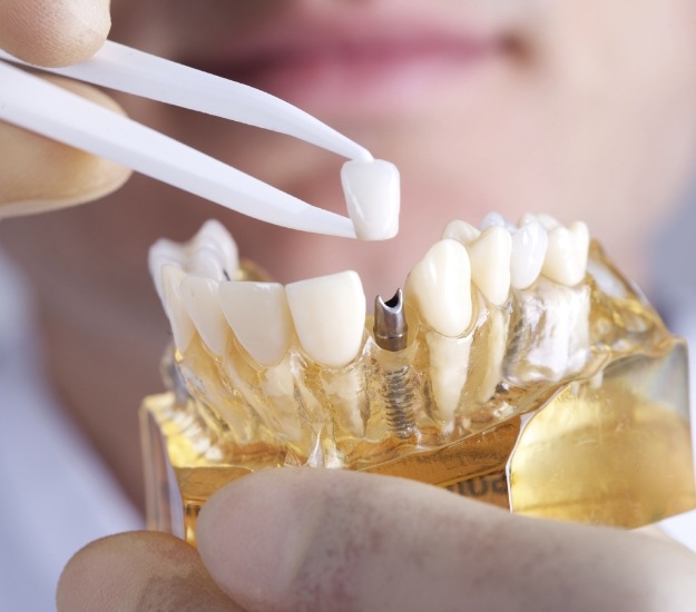Person placing dental crown on model of dental implant