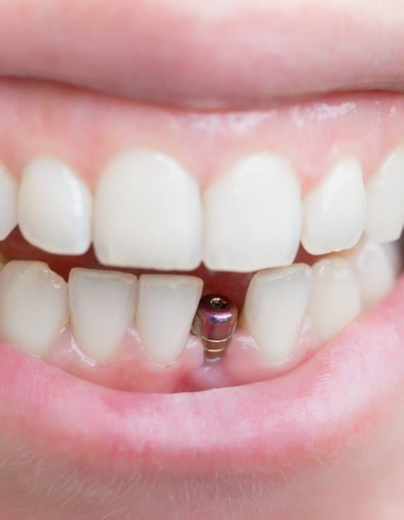 Close up of smile with a dental implant replacing a lower tooth