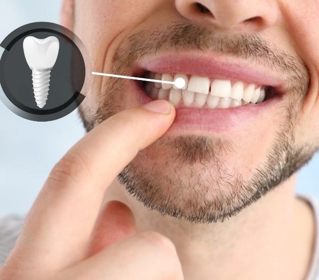Man pointing to his tooth next to illustration of dental implant