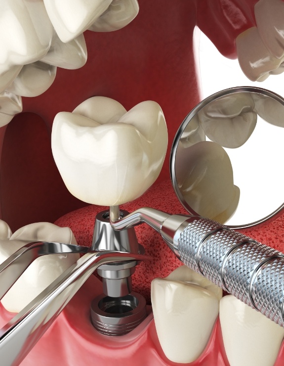 Illustrated dental implant abutment and crown being placed in lower arch