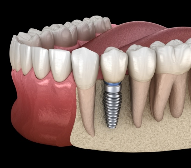 Illustrated dental implant integrated with the jawbone