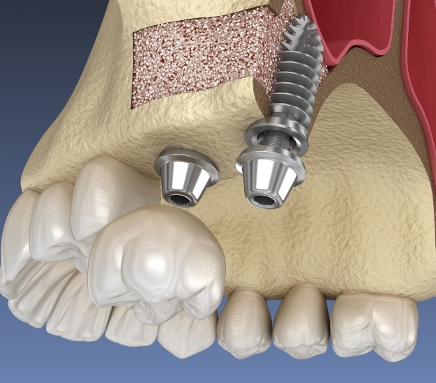 Illustrated dental crown being fitted onto implant in upper arch