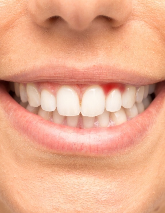 Close up of person with red spot in their gums