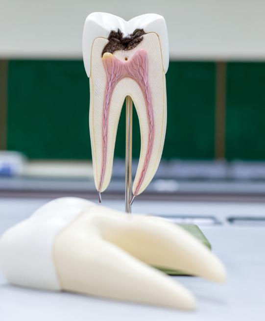 Model of decayed tooth needing root canal treatment in Arlington Heights