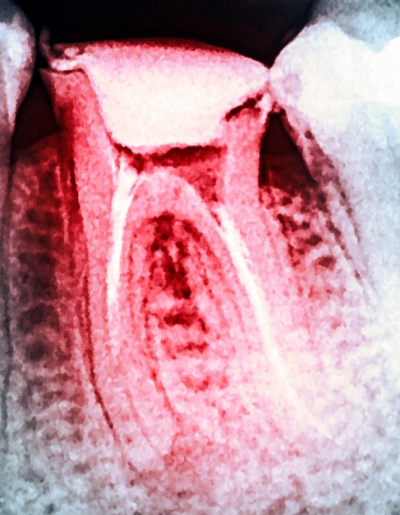 X ray of tooth highlighted red