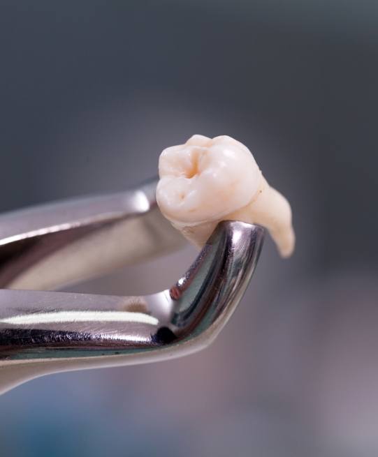 Dental forceps holding an extracted wisdom tooth