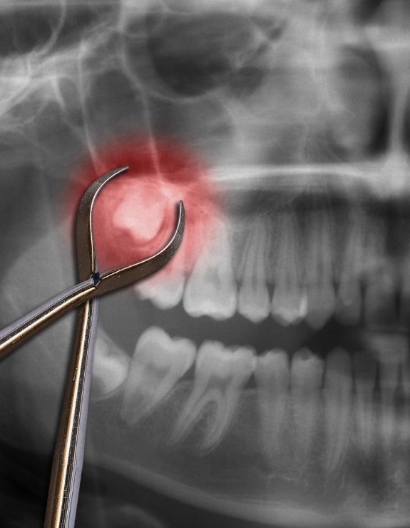 X ray of impacted wisdom tooth highlighted red