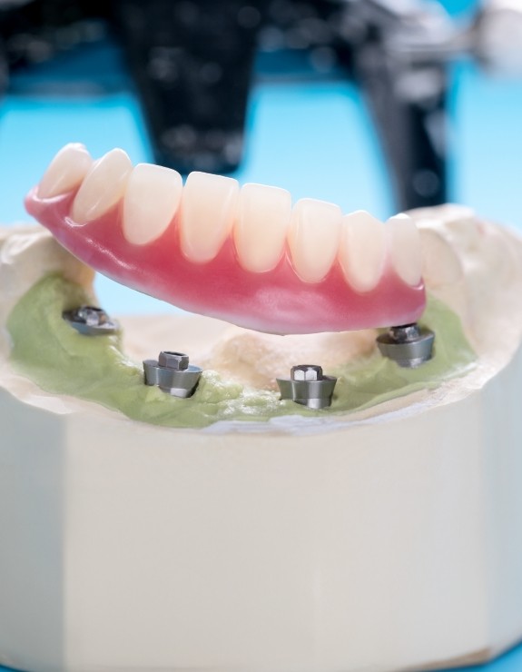 Model on desk of an All on 4 implant denture