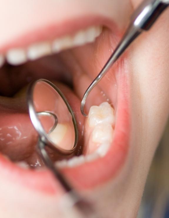 Close up of child receiving a dental exam