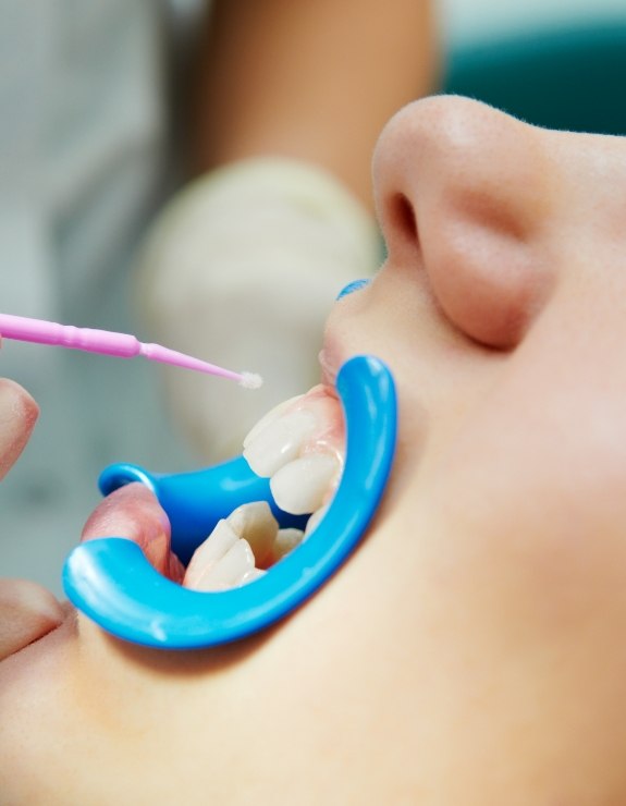 Close up of child having fluoride applied to their teeth