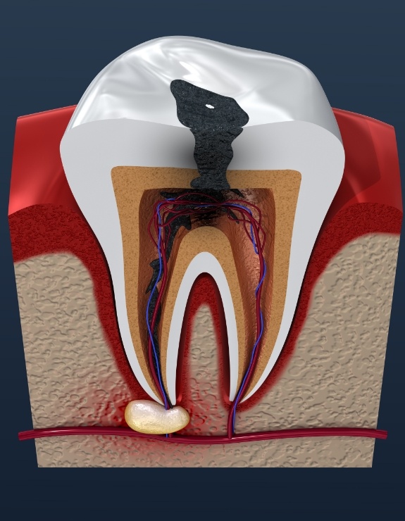 Illustrated decayed tooth