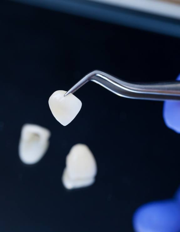 Dentist holding a veneer with tweezers