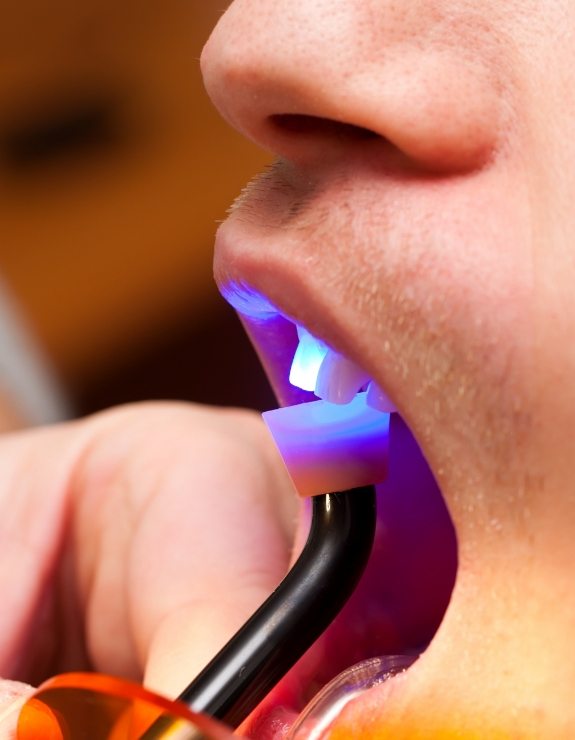 Close up of dental patient getting cosmetic bonding on upper front tooth