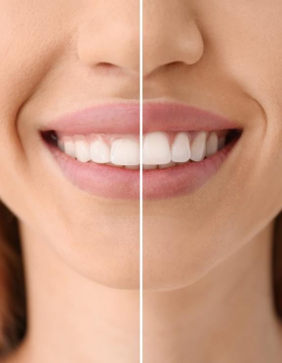 Close up of smile before and after gummy smile correction