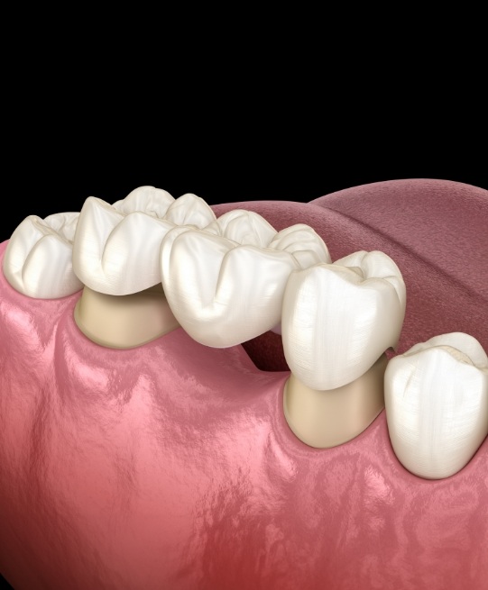 Illustrated dental bridge in Arlington Heights being placed