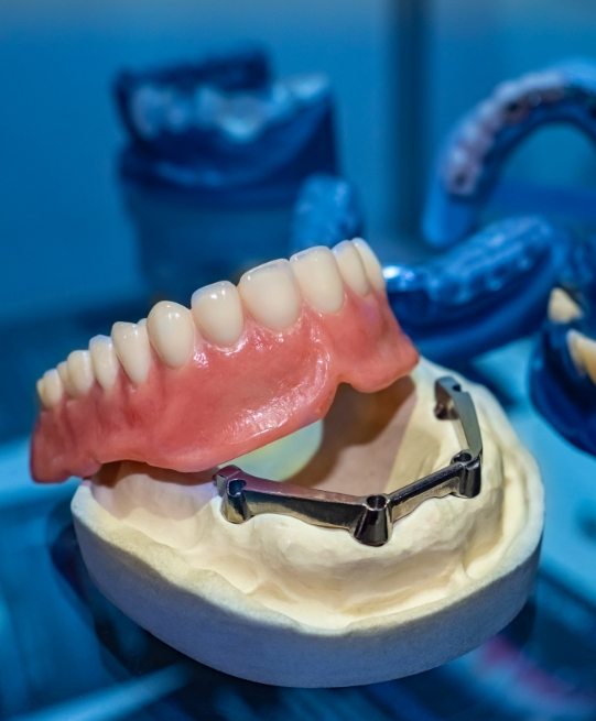 Model on desk of implant dentures in Arlington Heights