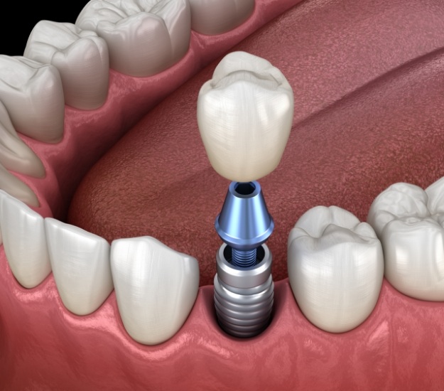 Illustrated dental crown being placed onto a dental implant