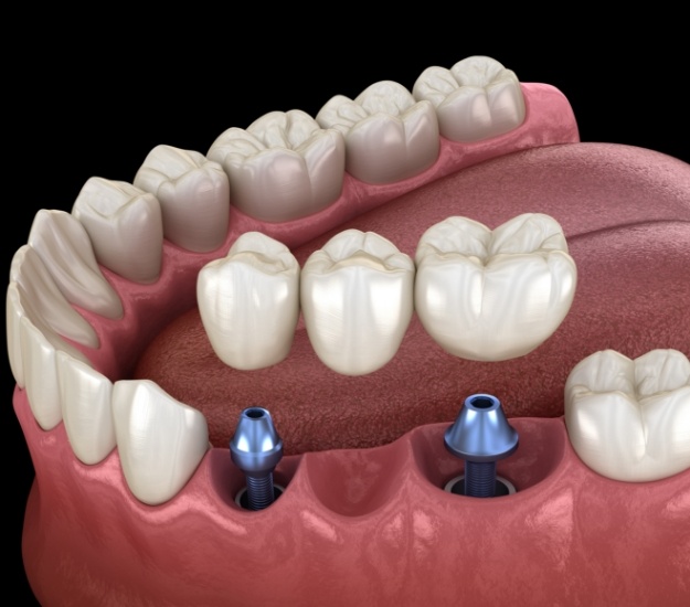 Illustrated dental bridge being placed onto two dental implants