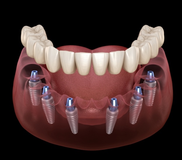 Illustrated denture being placed onto six dental implants