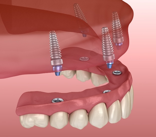 Illustrated implant denture being placed on the upper arch