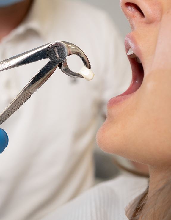 Nose-to-chin profile view of tooth being pulled with forceps from woman’s open mouth