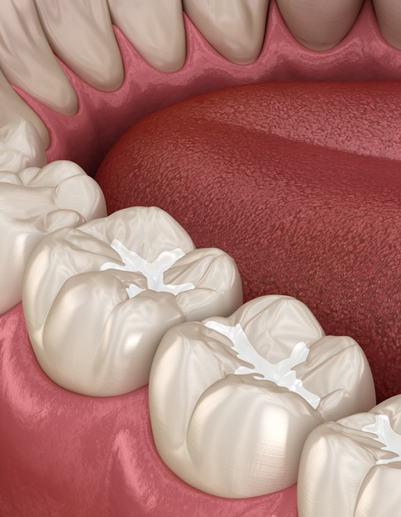 A 3D illustration of tooth-colored fillings