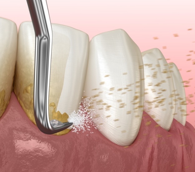 Illustrated dental scaler cleaning plaque from teeth