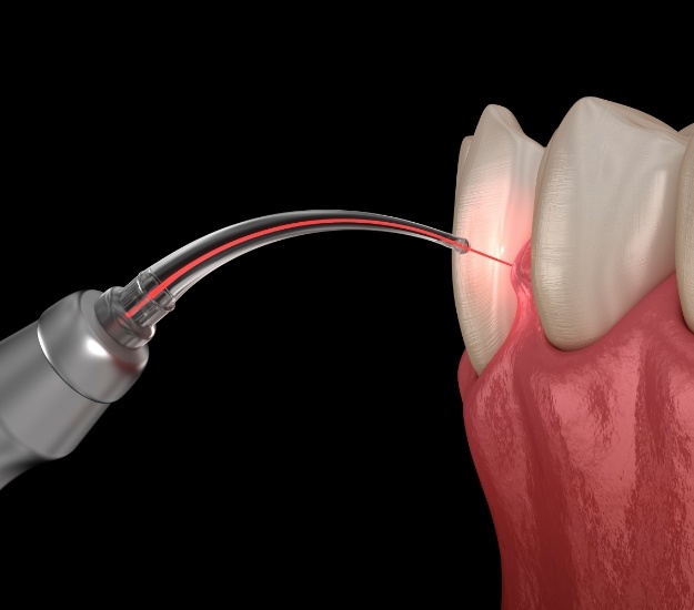 Illustrated dental laser treating gum disease