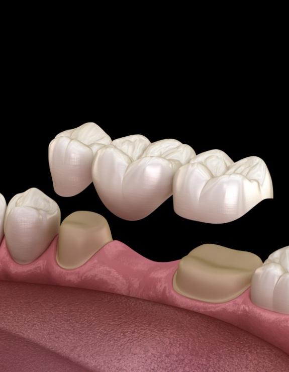 Illustrated dental bridge replacing a missing tooth