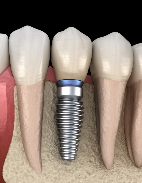 Illustrated dental implant replacing a missing tooth