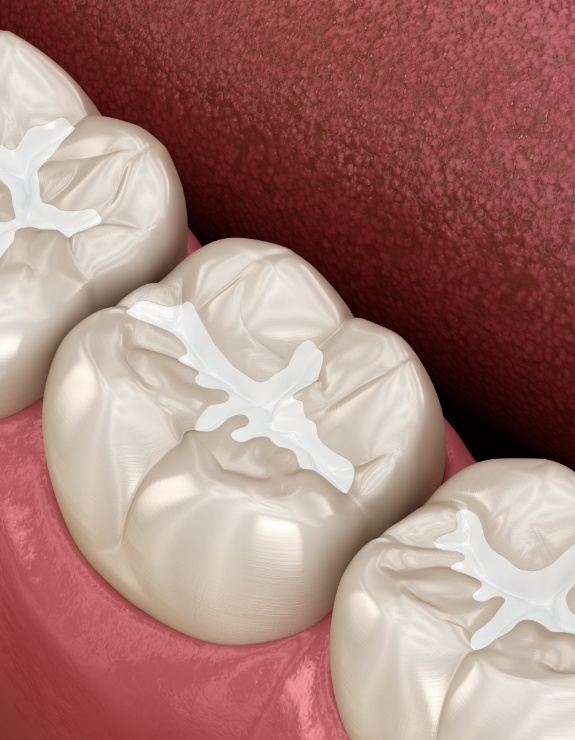 Illustrated row of teeth with white fillings