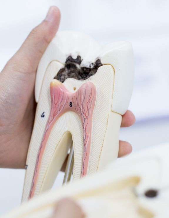 Hand holding a model of a decayed tooth