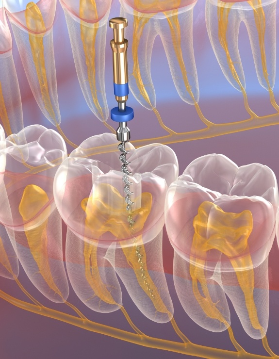 Illustrated dental instrument treating inside of tooth during root canal