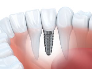 arlington heights implant dentist provides excellent care