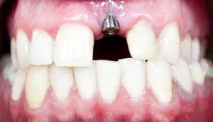 gapped teeth with dental implant