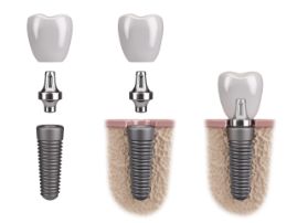 Model of the 3 stages of implant placement