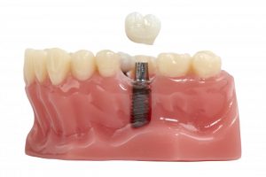 Dental Implant Model