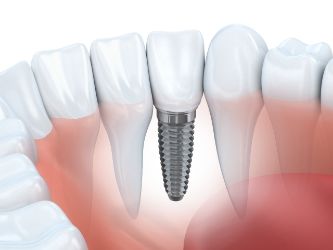 Image of a dental implant replacing a bottom front tooth