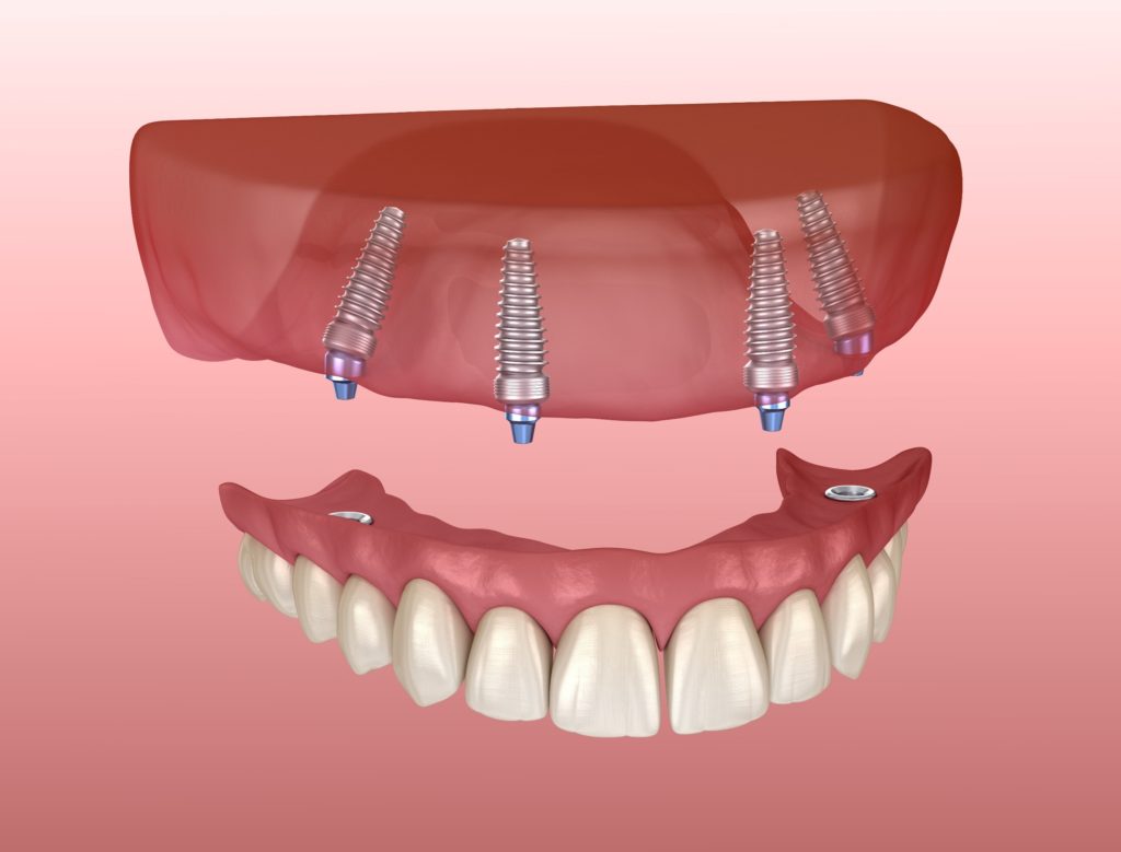 Discover the Benefits of Dental Implants to Secure Your Denture