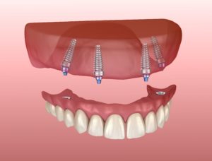 Image of dental implants supporting a denture.