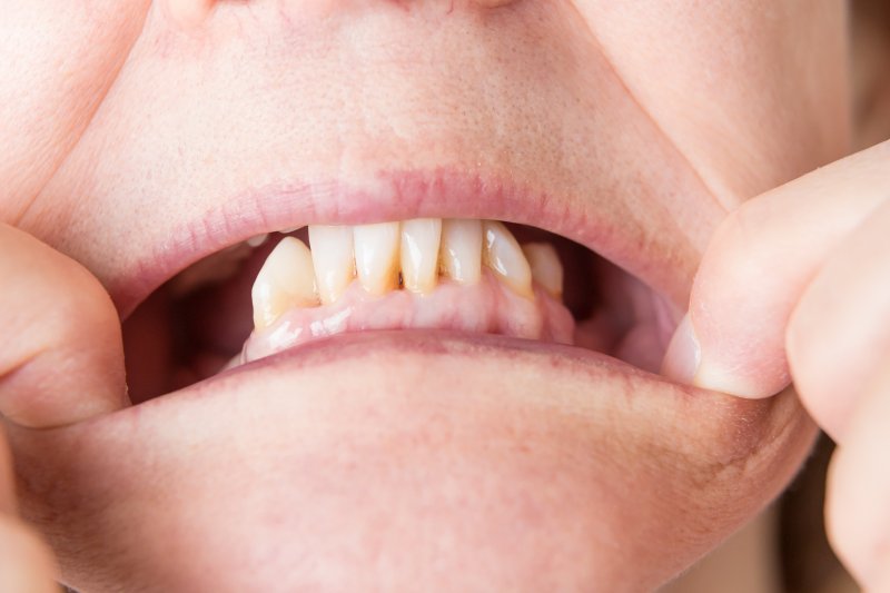 Replacig Missing Back Teeth | Costello and DeHart Dental Excellence