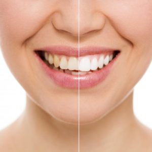 woman happy with teeth whitening