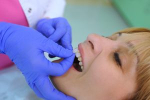 a woman receiving veneers at the dentist