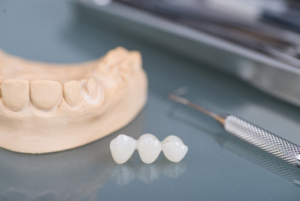 Dental bridge sitting on a table next to a plaster model of teeth