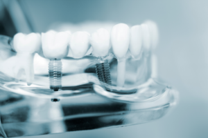 a model of a mouth with dental implants