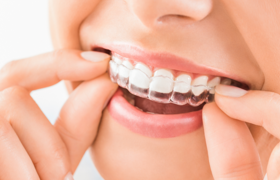 Woman fitting clear aligner